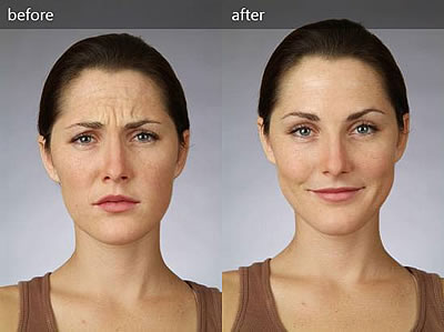 botox